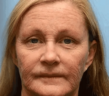 Gewinnen Sie jetzt jugendliche Haut zurück💫BOTOX & VITA A RETINOL SHOT Faltenglättende Straffungscreme